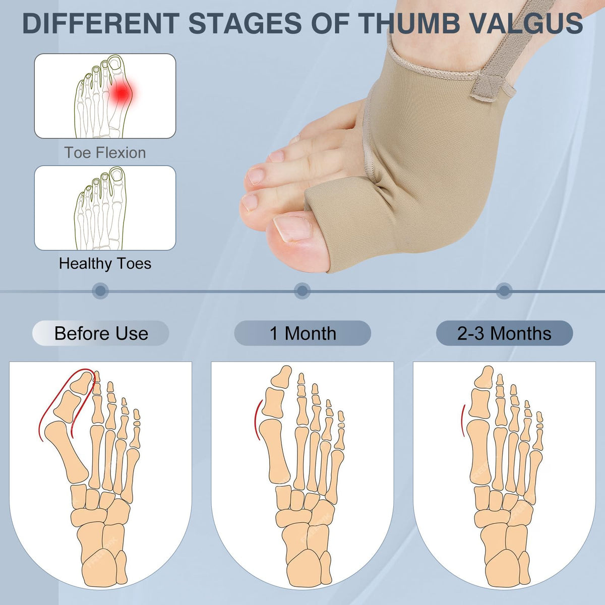 KTSAY 2PCS Bunion Corrector for Women & Men, Big Toe Straightener with Splint & Pads, Comfortable & Breathable for Day/Night Support, Hallux Valgus Pain Relief Non-Slip Socks (1, Beige)