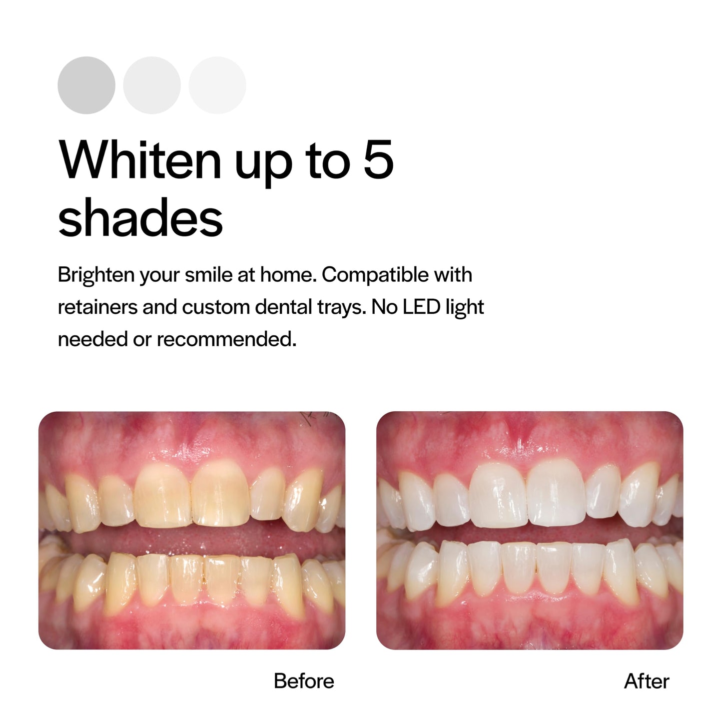 Opalescence 35% CP Mint - Gel Syringes Teeth Whitening - Refill Kit (2 Packs / 4 Syringes Total) Carbamide Peroxide Gel. Made by Ultradent. Tooth Whitening Refill Syringes 5197-2