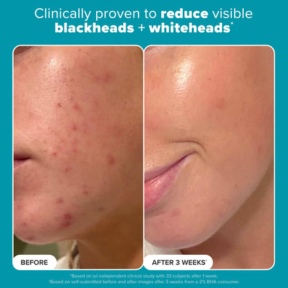 Paulas Choice--SKIN PERFECTING 2% BHA Liquid Salicylic Acid Exfoliant--Facial Exfoliant for Blackheads, Enlarged Pores, Wrinkles & Fine Lines, 4 oz Bottle