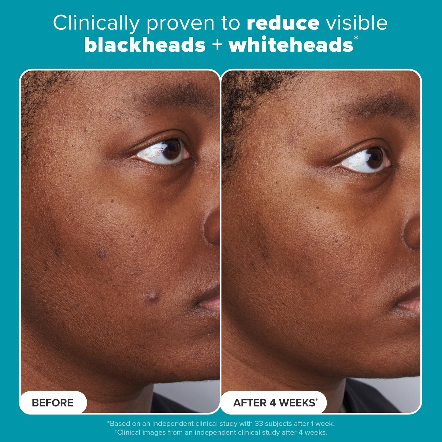 Paulas Choice--SKIN PERFECTING 2% BHA Liquid Salicylic Acid Exfoliant--Facial Exfoliant for Blackheads, Enlarged Pores, Wrinkles & Fine Lines, 4 oz Bottle